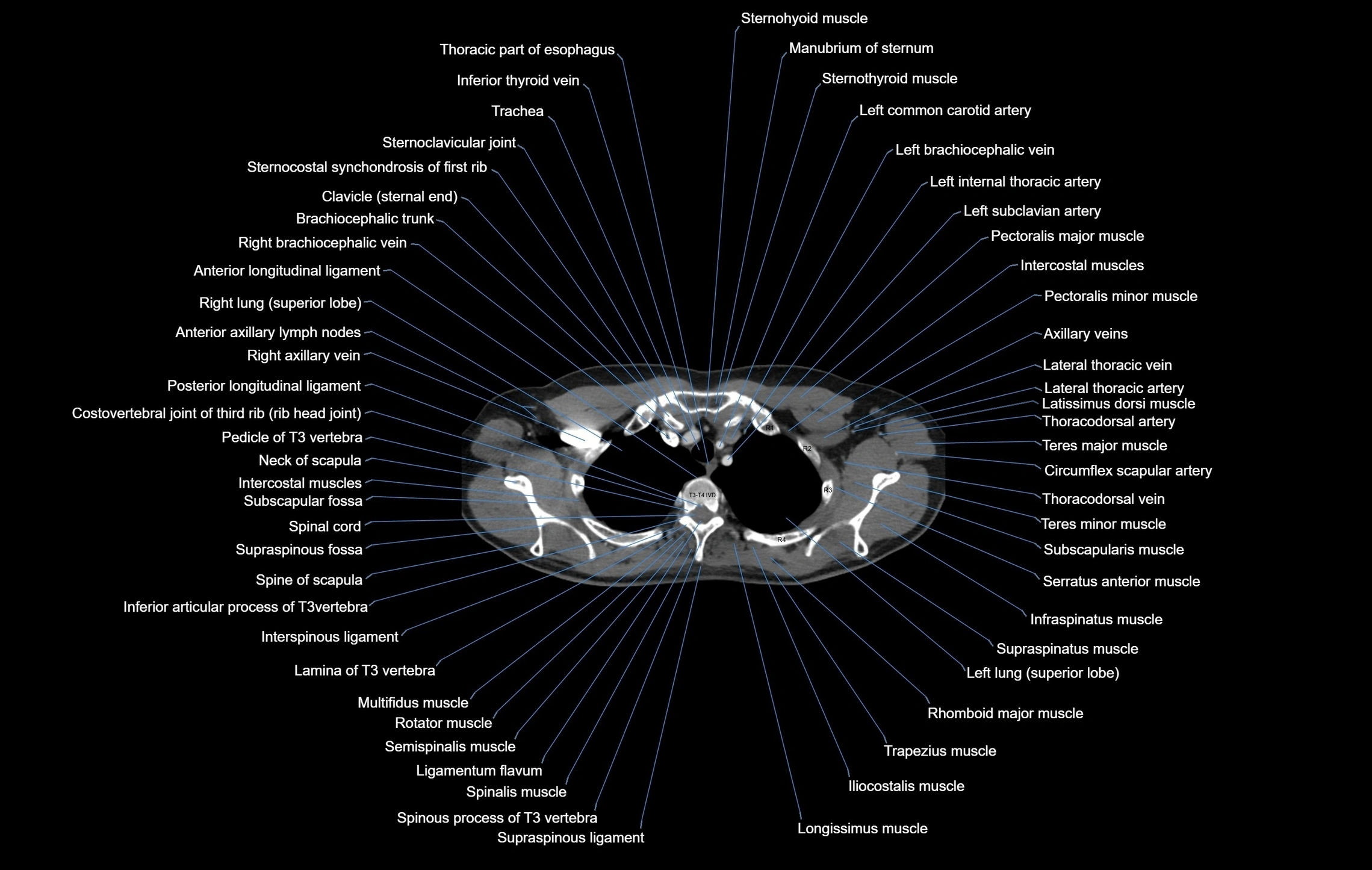 CT chest (thorax) labelled axial cross sectional anatomy radiology image-00020.webp